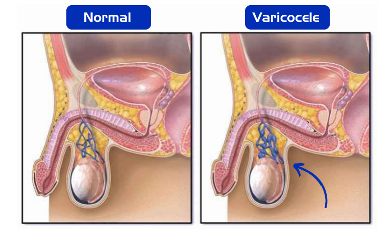 Alerta: varicocele é a principal causa de infertilidade masculina